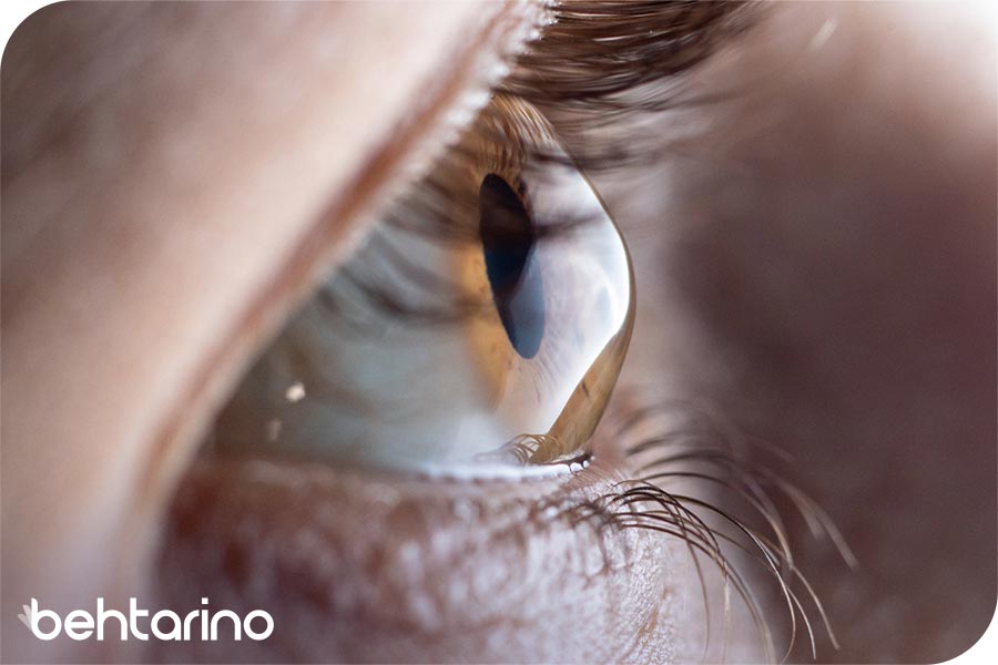 عمل قوز قرنیه
